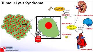 Tumour Lysis Syndrome [upl. by Rosol]