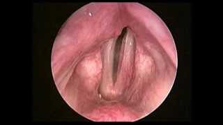 左側聲帶麻痺術前left vocal fold paralysis preop [upl. by Auqeenahs826]