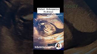 Fetal echogenic kidneys  Dr Surbhi Gupta Aggarwal  Consultant Radiologist [upl. by Landon]