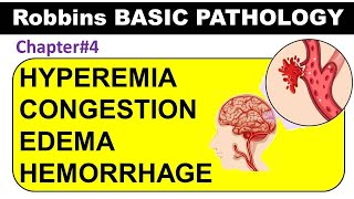 Chp4 Part1 Robbins Basic Patho  Hyperemia  Congestion  Edema  Hemorrhage  General Pathology [upl. by Yevrah]