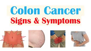 Colon Cancer CRC Signs amp Symptoms amp Why They Occur [upl. by Shurwood285]