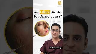 Fillers for acne scars  Dr Sanjeev Nelogi  Glow Skin Clinic [upl. by Callas939]