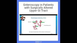 Enteroscopy in Patients with Surgically Altered Upper GI Tract [upl. by Septima725]