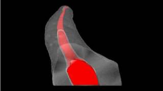 Mct  Curved Root Canal Treated Using the SAF System [upl. by Fidelas]