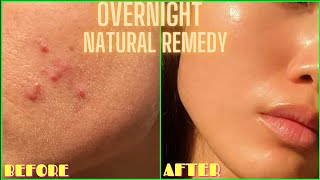 HOW TO GET RID OF ACNE PIMPLES BUMPS ON FACE OVERNIGHT  Simple Home Remedy DIY Lemon Treatment [upl. by Maisey]