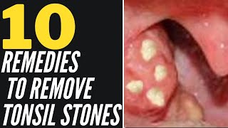 How To Remove Tonsil Stones Naturally 10 Home Remedies That Work [upl. by Marek]