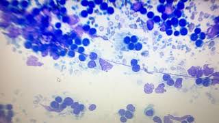 Lymphoma Cytological grading [upl. by Kenison171]