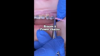 Braces and Power Chains 6 to 6  Tooth Time Family Dentistry New Braunfels Texas [upl. by Navar]