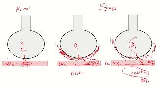 Diffuse Parenchymal Lung Disease ILD and Occupational Lung Disease Part 1 [upl. by Hakkeber]