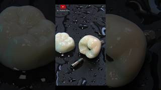 Dental crowns vs dental implant shorts [upl. by Aihtenak823]