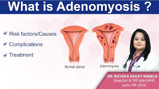 What is Adenomyosis Treatments Symptoms and Causes Dr Richika Sahay Shukla  India IVF Clinic [upl. by Ailama179]