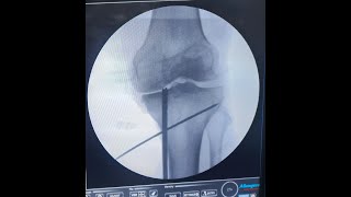 MEDIAL MENISCUS ROOT TRANSTIBIAL PULL OUT REPAIR [upl. by Adnalram]