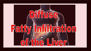 Diffuse Fatty Infiltration of the Liver [upl. by Asenav699]