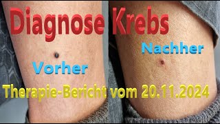 Diagnose KREBS  TherapieBericht vom 20112024 [upl. by Celinda]