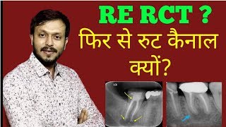 What is Re Rct  Re root canal treatment kya hota hai [upl. by Oznol]