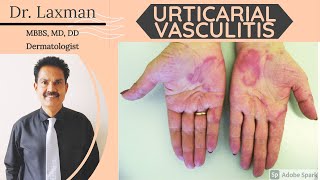 Urticarial Vasculitis  Vasculitis  Causes amp Symptoms amp Treatment Vasculitis Allergy Dermatology [upl. by Lipsey]