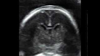 How to image the fetal corpus callosum [upl. by Keli]