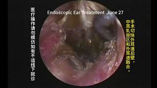 Follow up cleaning after 20 years of cholesteatoma surgery [upl. by Dazraf794]