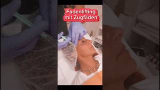 Fadenlifting mit Zugfäden SO funktionierts [upl. by Yllah813]