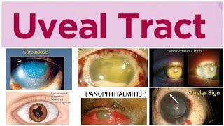 Uveal Tract 3 Major Topic Endophthalmitis [upl. by Anayt]