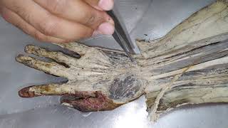 dissection of superficial palmar arch of ulnar artery [upl. by Enair89]