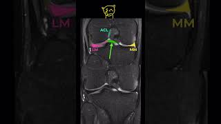 3Fig 1A17 Oblique meniscomeniscal ligament [upl. by Manlove]