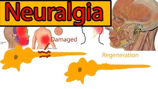 Neuralgia Explained under 3 minutes Trigeminal Neuralgia symptoms and treatment [upl. by Ahsilrak486]