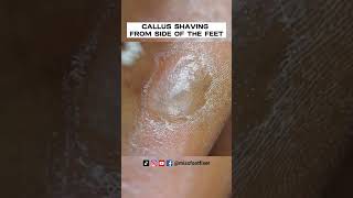 LARGE CALLOUS SHAVING 2023  CALLUS SHAVING FROM SIDE OF THE FEET  SATISFYING BY MISS FOOT FIXER [upl. by Sugihara385]