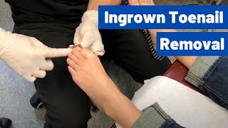 Ingrown Toenail Removal Surgery Video  Permanent Cosmetic Procedure [upl. by Zoellick950]