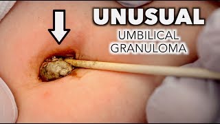 UNUSUAL UMBILICAL GRANULOMA Cauterized With Silver Nitrate  Dr Paul [upl. by Nnaegroeg968]