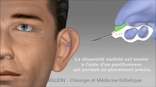 Earfold  une technique non chirurgicale pour les oreilles décollées  Dr Corniglion [upl. by Eak]