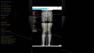 Osteotomy App [upl. by Bael]