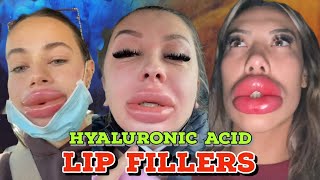 LIP INJECTIONS WITH NO NEEDLE [upl. by Ytomit]