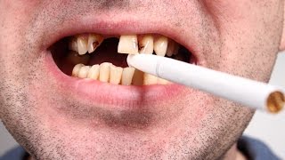 HOW DOES SMOKING AFFECT YOUR TEETH  Tooth Loss  Bleeding Gums  NYC Dentist [upl. by Orimisac436]