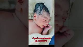 caput succedaneum of a newbornnewbornbaby babyshorts [upl. by Carper]