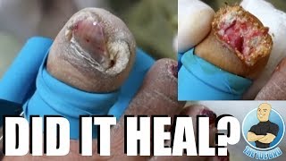 THE CRAZIEST TOENAIL EVER WITH WARTS AND FUNGUS 1 YEAR FOLLOWUP [upl. by Acinhoj]