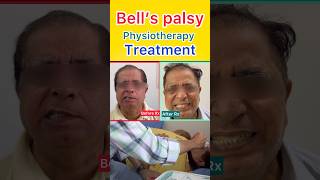 Bell’s palsy treatment  Best doctor for bell’s palsy shorts bellspalsy bellspalsytreatment [upl. by Euphemie]