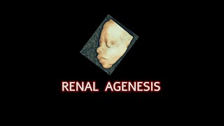 renal agenesis v [upl. by Stephenson]