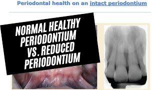 Normal Healthy Periodontium vs Reduced Periodontium [upl. by Meares359]