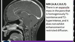 Diffuse Intrinsic Pontine Glioma Brain stem tumor [upl. by Zurek127]