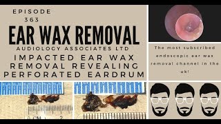 IMPACTED EAR WAX REMOVAL REVEALING PERFORATED EARDRUM EP363 [upl. by Ursel341]