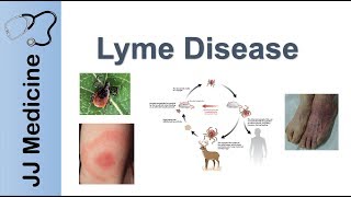 Lyme Disease  Pathophysiology Signs and Treatment [upl. by Wendolyn598]