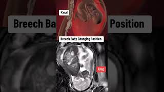 breech baby changing his position inside Womb during ultrasound scan pregnancy babyultrasound [upl. by Harhay]