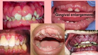 gingival enlargement [upl. by Artened]