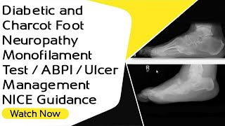 Diabetic and Charcot Foot  Neuropathy  Monofilament Test  ABPI  Ulcer Management  NICE Guidance [upl. by Naelcm]