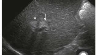 Case 0088 biliary atresia [upl. by Storz]