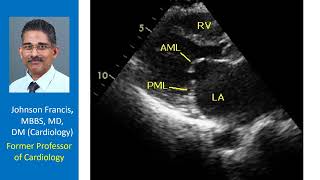 This echocardiogram was taken in parasternal long axis view What is the diagnosis [upl. by Niai]