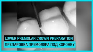 Lower premolar crown preparation Препаровка нижнего премоляра под коронку [upl. by Parry272]