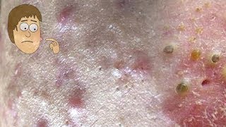 A Few How To Remove Blackheads On The Face Easy 44 [upl. by Derrek986]