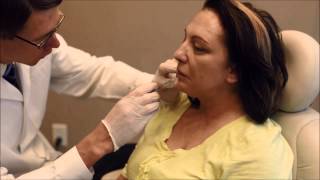 Patient Receives Juvederm Ultra Plus XC Treatment [upl. by Eatnuhs]